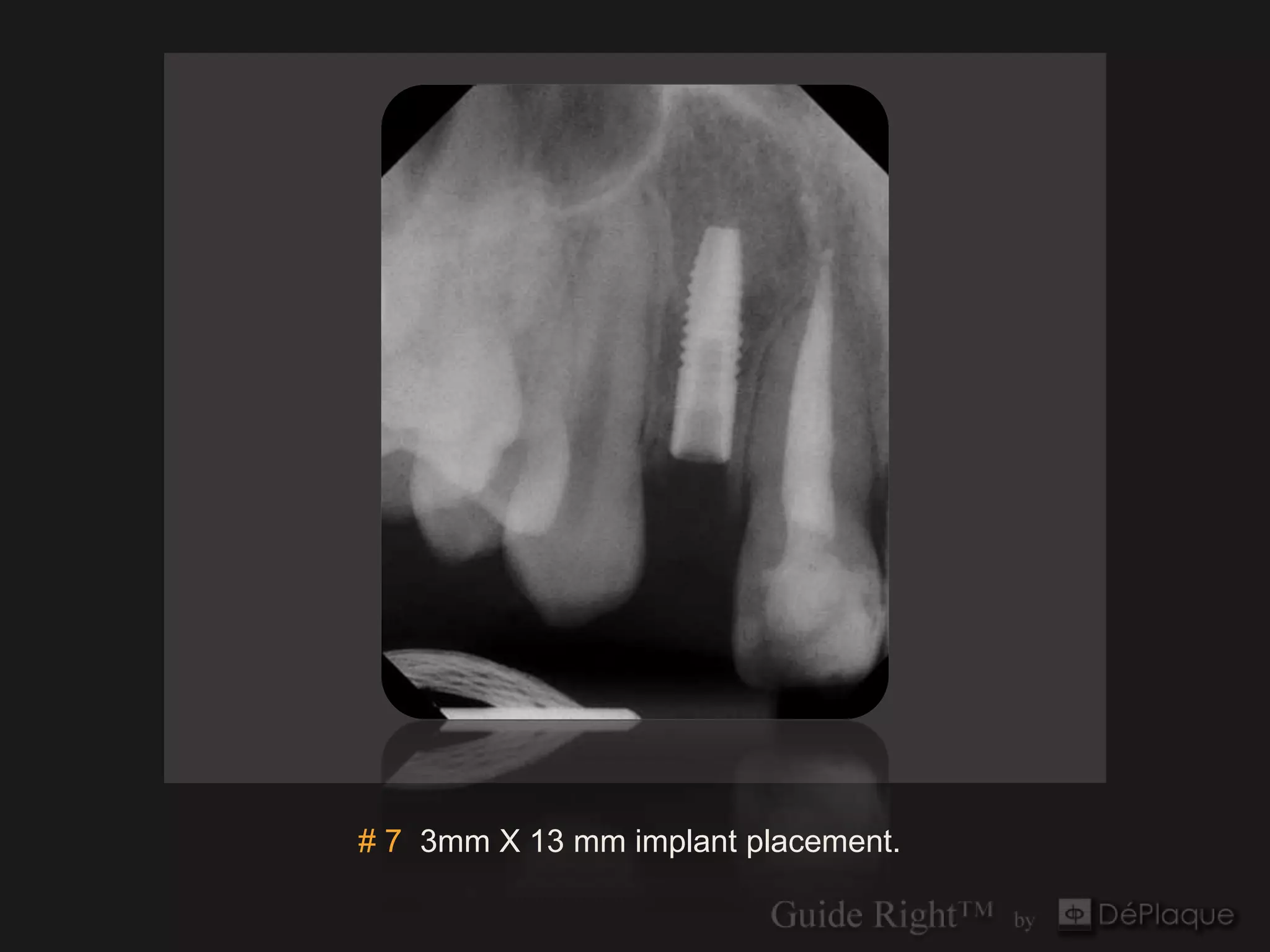 # 7 3mm X 13 mm implant placement.
 