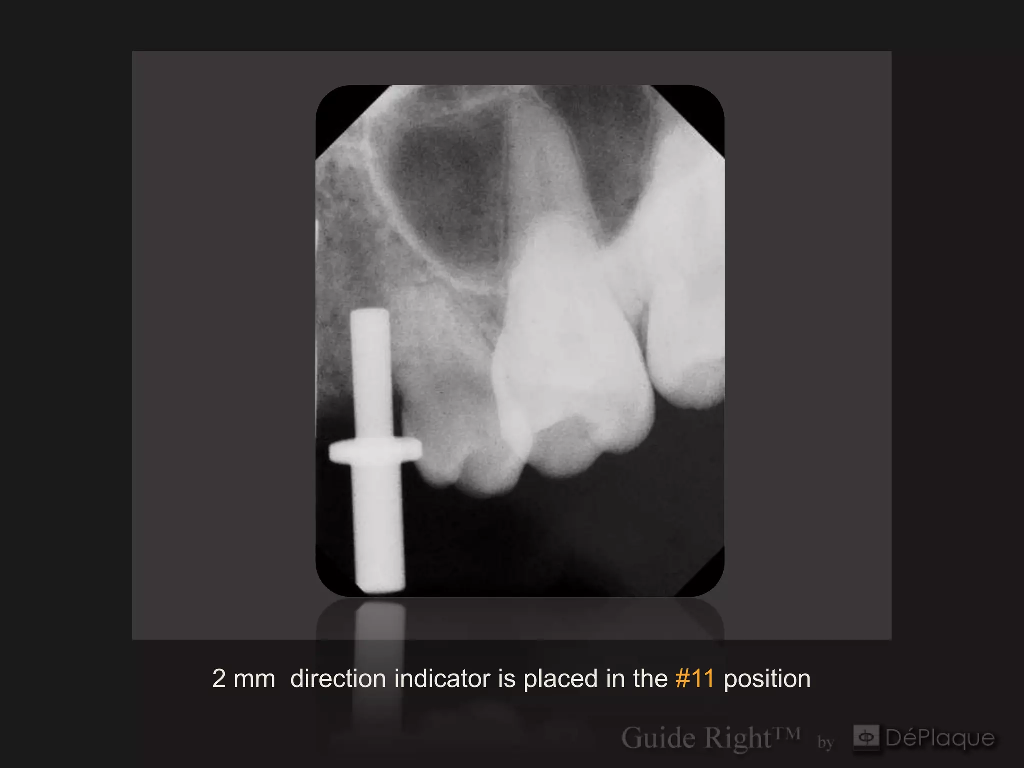 `




2 mm direction indicator is placed in the #11 position
 