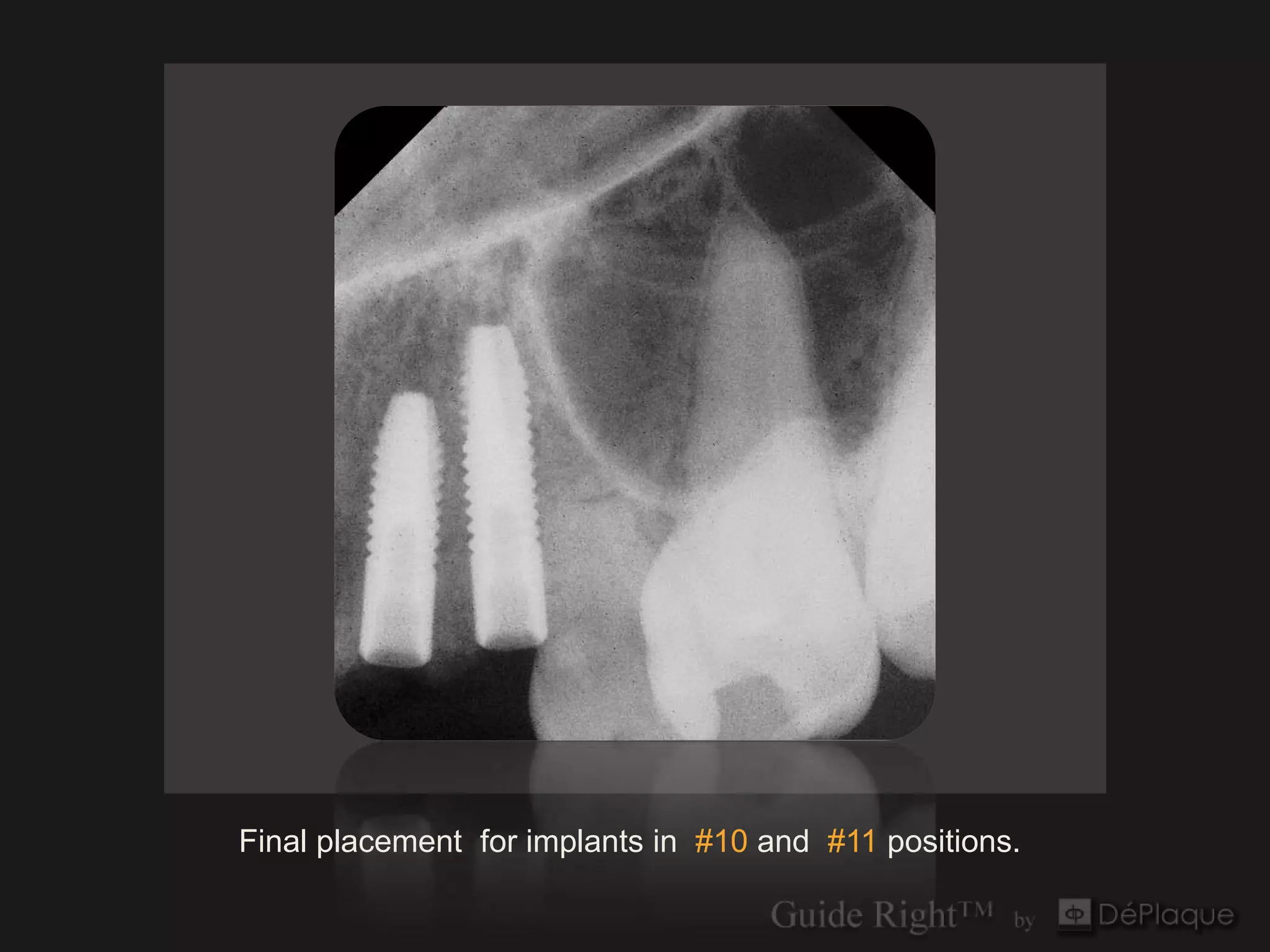 `




Final placement for implants in #10 and #11 positions.
 