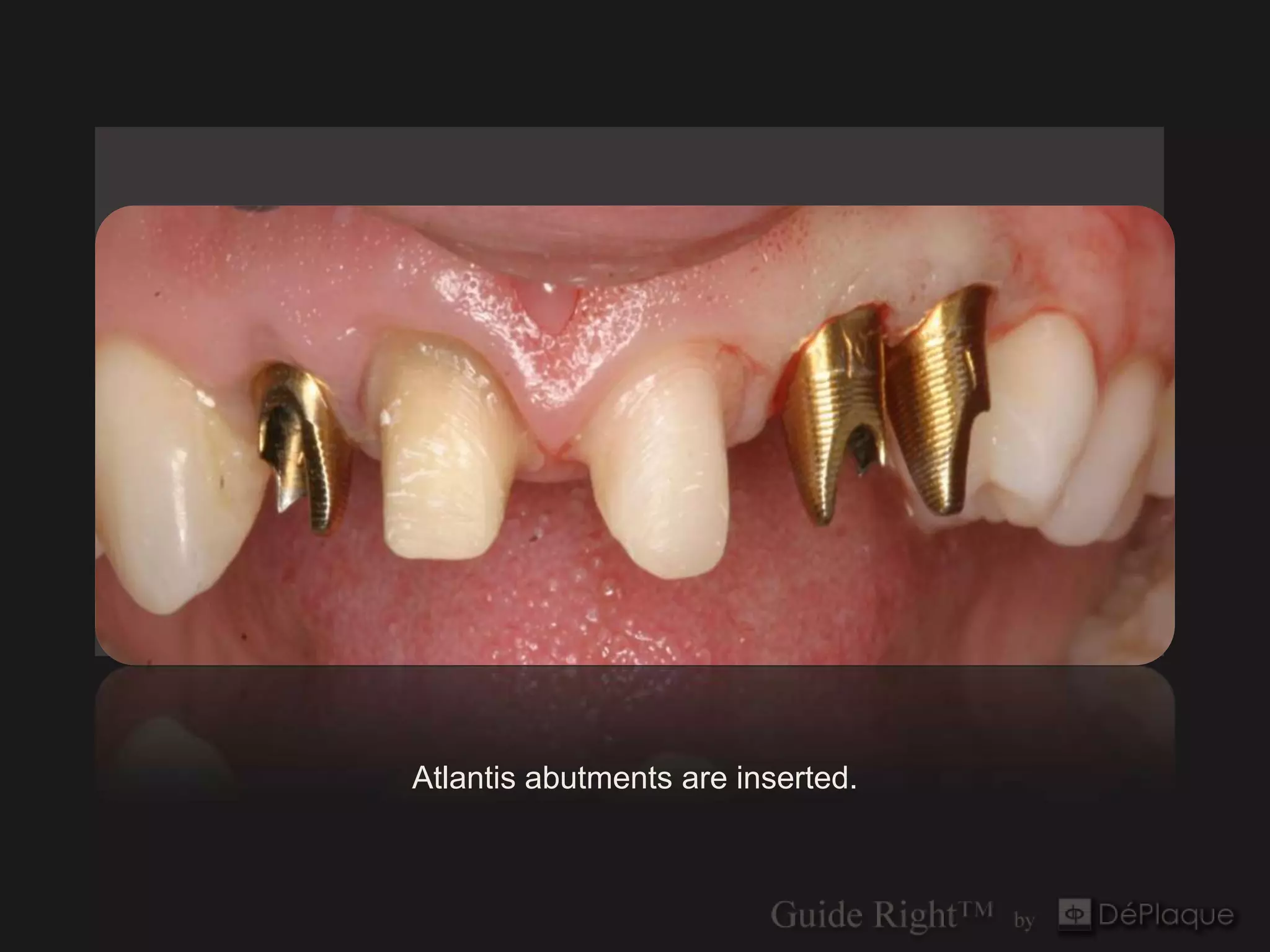 `




Atlantis abutments are inserted.
 