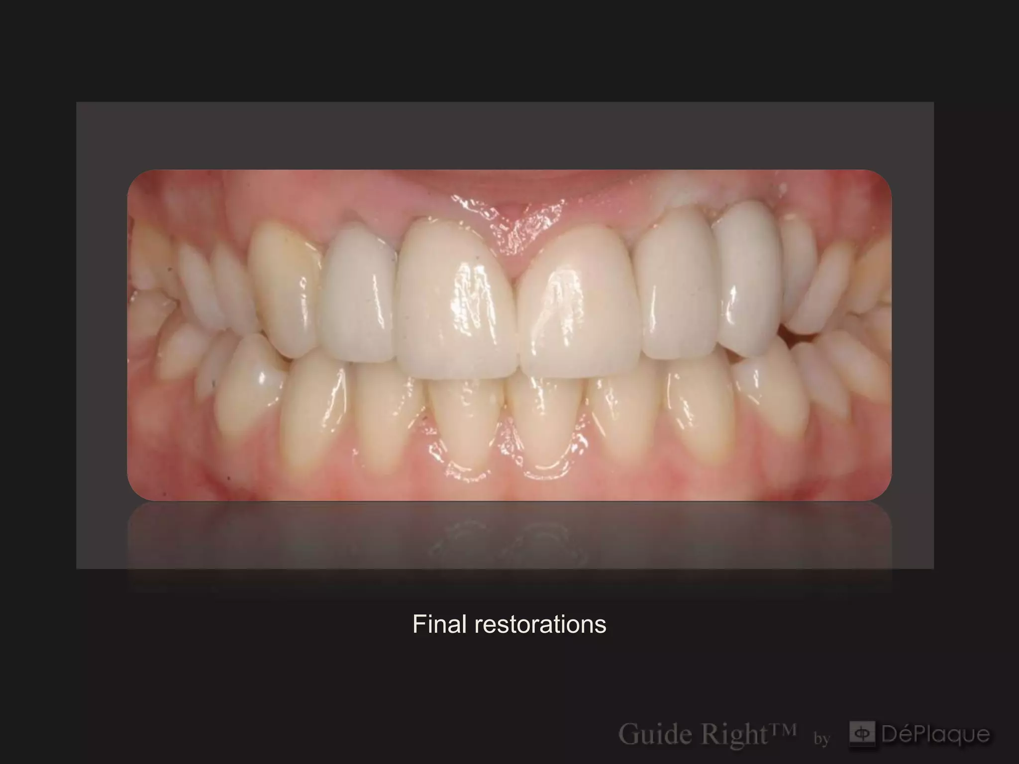 `




Final restorations
 