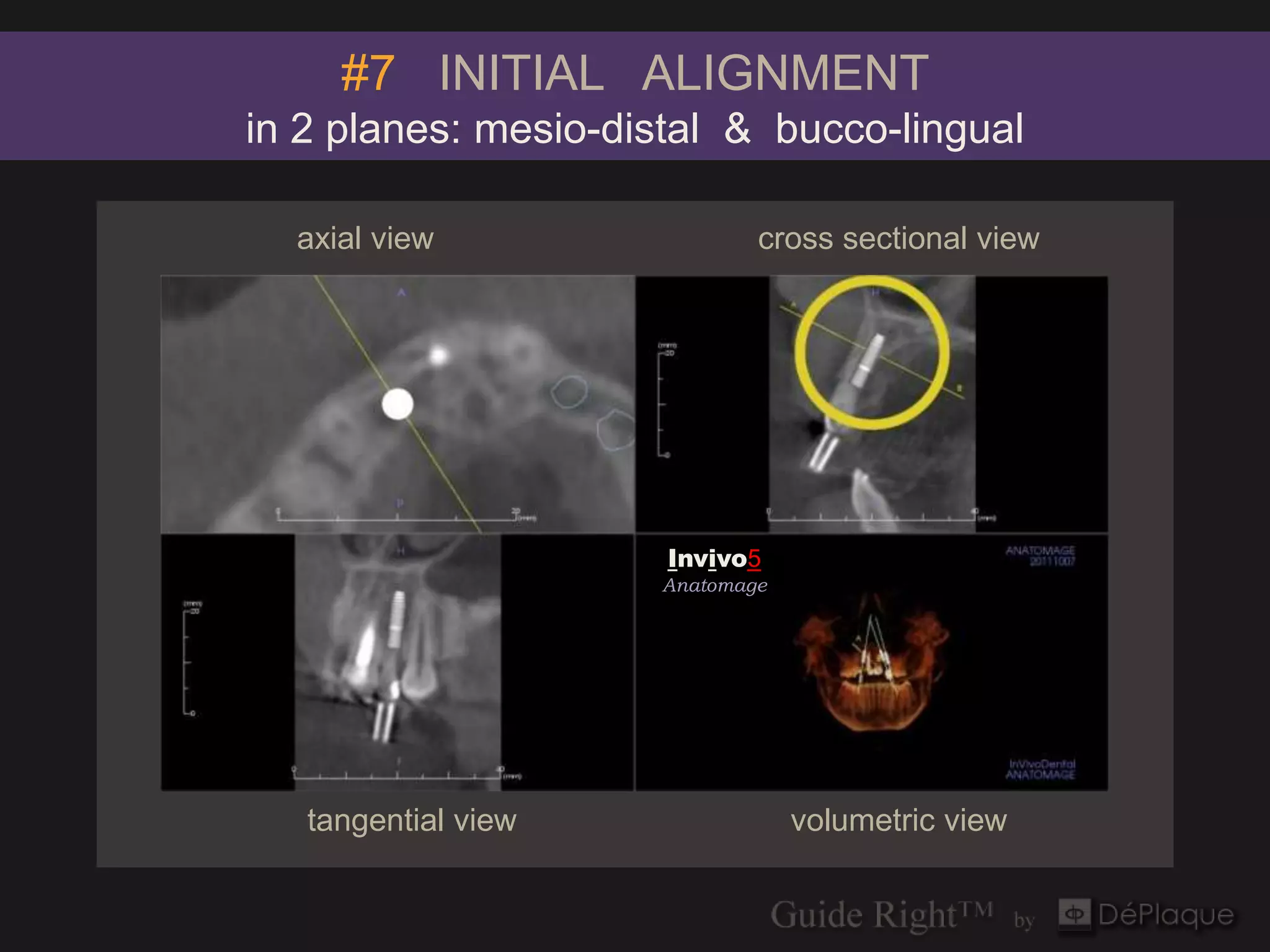 #7 INITIAL ALIGNMENT
in 2 planes: mesio-distal & bucco-lingual

  axial view                     cross sectional view



                     `



                         Invivo5
                         Anatomage




   tangential view                   volumetric view
 