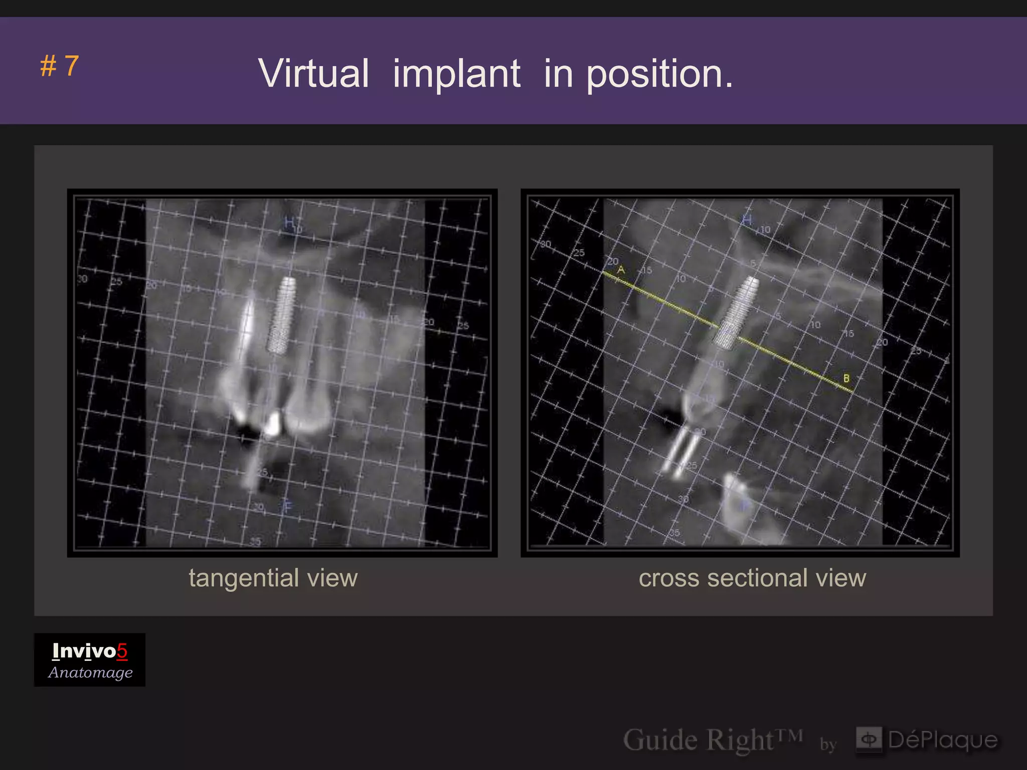#7                Virtual implant in position.




            tangential view             cross sectional view

Invivo5
Anatomage
 