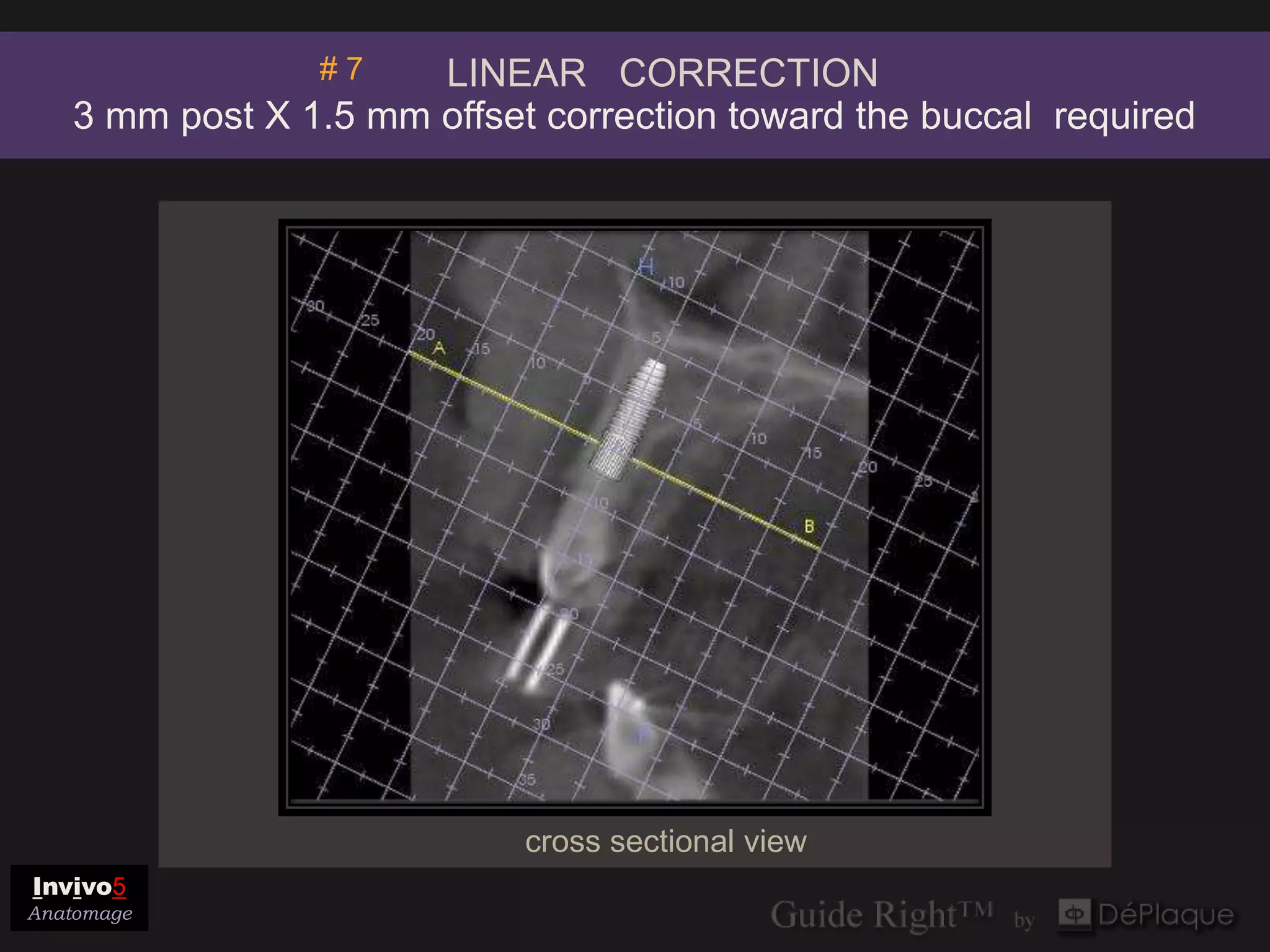 #7    LINEAR CORRECTION
   3 mm post X 1.5 mm offset correction toward the buccal required




                            cross sectional view
Invivo5
Anatomage
 
