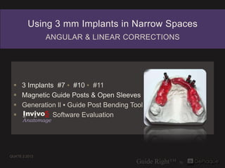 Using 3 mm Implants in Narrow Spaces
               ANGULAR & LINEAR CORRECTIONS




     3 Implants #7 ▪ #10 ▪ #11
     Magnetic Guide Posts & Open Sleeves
     Generation ll ▪ Guide Post Bending Tool
     Invivo5 Software Evaluation
      Anatomage




QUATE 2.2013
 