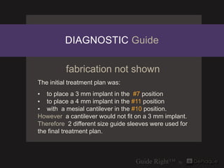 DIAGNOSTIC Guide

          fabrication not shown
The initial treatment plan was:
▪ to place a 3 mm implant in the #7 posi...
