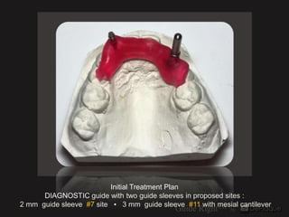 `




                         Initial Treatment Plan
      DIAGNOSTIC guide with two guide sleeves in proposed sites :
2 ...