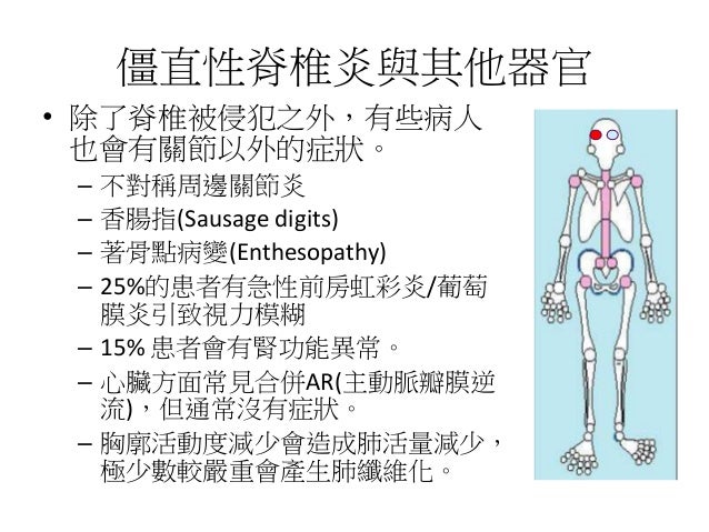 強直 性 脊椎 炎