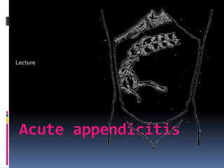 Acute appendicitis
Lecture
 