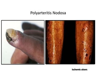 Polyarteritis Nodosa
Ischemic ulcers
 