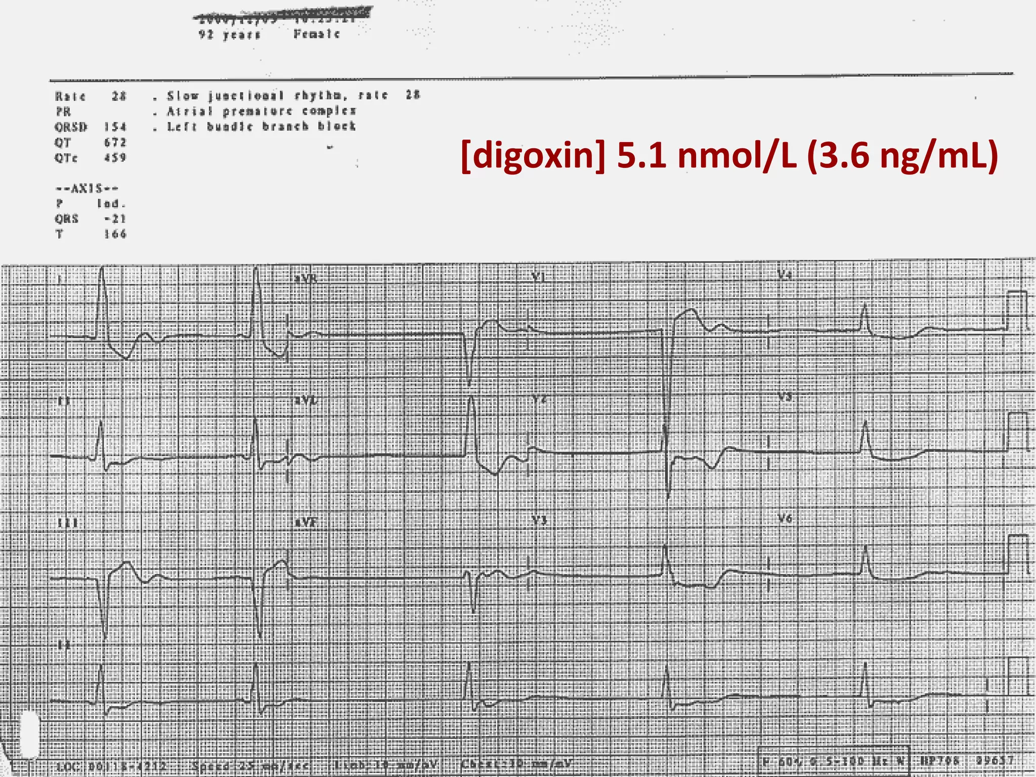 [digoxin] 5.1 nmol/L (3.6 ng/mL)
 