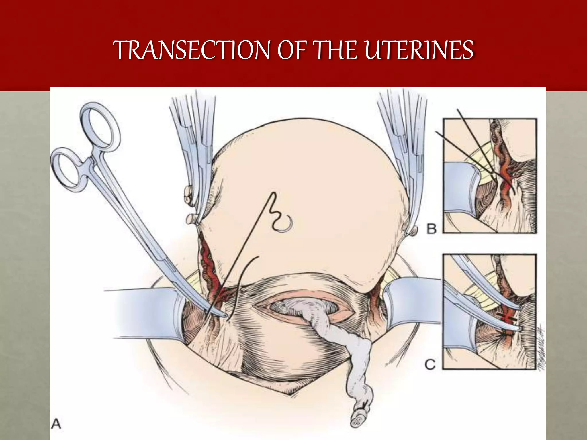TRANSECTION OF THE UTERINES
 