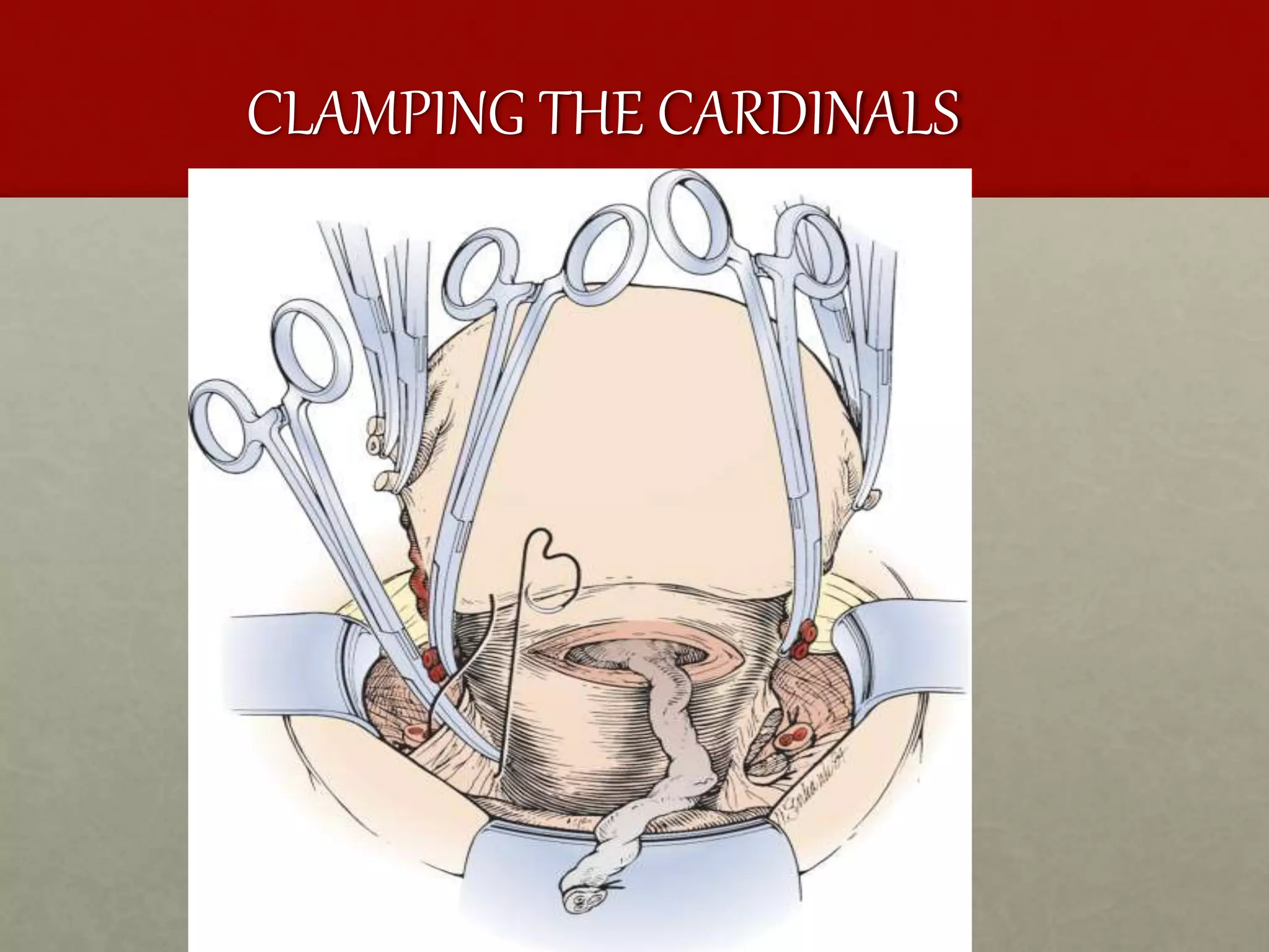 CLAMPING THE CARDINALS
 