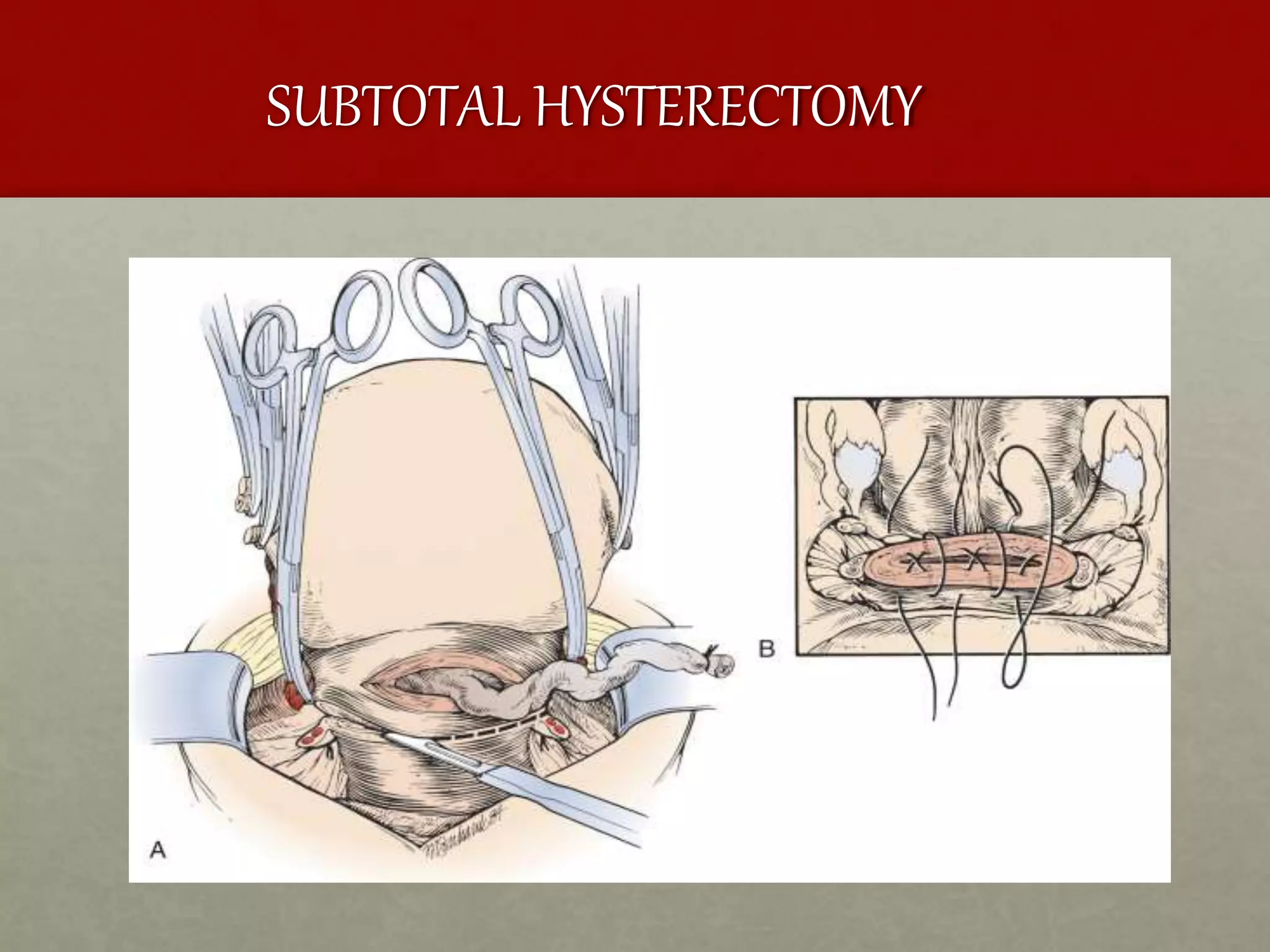 SUBTOTAL HYSTERECTOMY
 