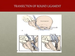 TRANSECTION OF ROUND LIGAMENT
 