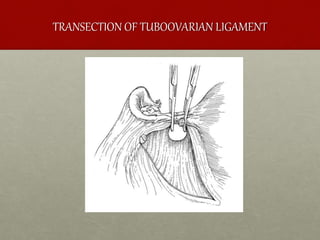 TRANSECTION OF TUBOOVARIAN LIGAMENT
 