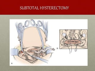 SUBTOTAL HYSTERECTOMY
 