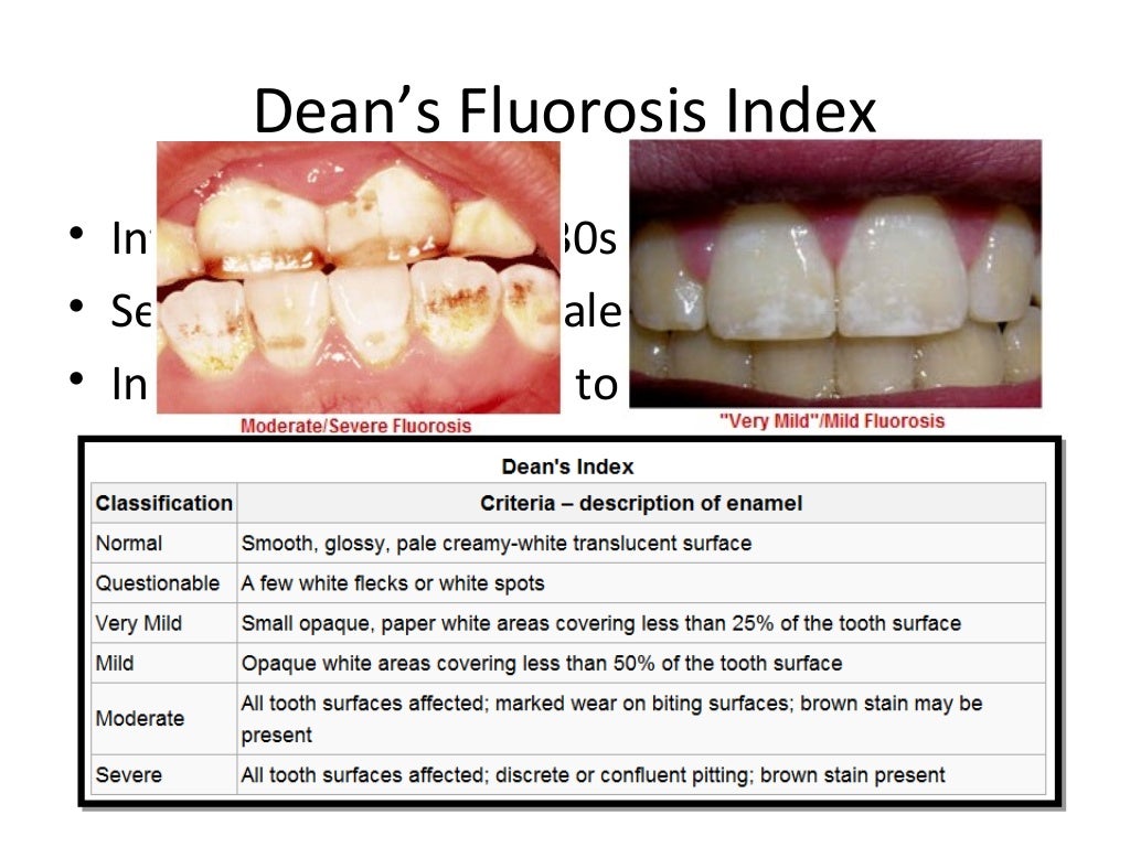 Dental Fluorosis