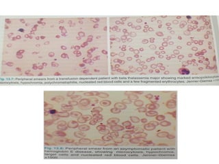 105 Hemolytic anemia-1 thalassemia and sickle cell anemia | PPTX