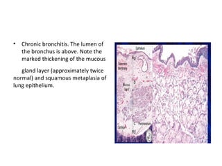 • Chronic bronchitis. The lumen of
the bronchus is above. Note the
marked thickening of the mucous
gland layer (approximately twice
normal) and squamous metaplasia of
lung epithelium.
 