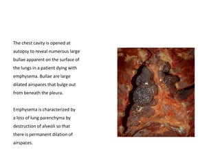 The chest cavity is opened at
autopsy to reveal numerous large
bullae apparent on the surface of
the lungs in a patient dying with
emphysema. Bullae are large
dilated airspaces that bulge out
from beneath the pleura.
Emphysema is characterized by
a loss of lung parenchyma by
destruction of alveoli so that
there is permanent dilation of
airspaces.
 