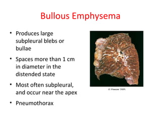 Bullous Emphysema
• Produces large
subpleural blebs or
bullae
• Spaces more than 1 cm
in diameter in the
distended state
• Most often subpleural,
and occur near the apex
• Pneumothorax
 