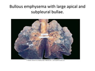 Bullous emphysema with large apical and
subpleural bullae.
 