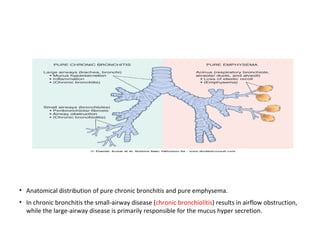 • Anatomical distribution of pure chronic bronchitis and pure emphysema.
• In chronic bronchitis the small-airway disease (chronic bronchiolitis) results in airflow obstruction,
while the large-airway disease is primarily responsible for the mucus hyper secretion.
 