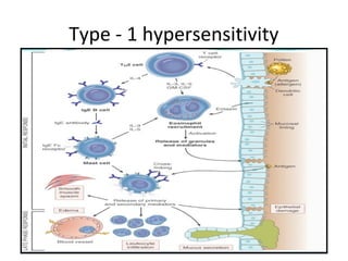Type - 1 hypersensitivity
 