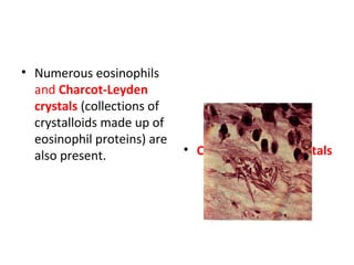• Numerous eosinophils
and Charcot-Leyden
crystals (collections of
crystalloids made up of
eosinophil proteins) are
also present. • Charcot-Leyden crystals
 