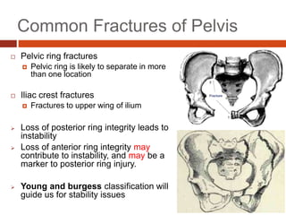 Common Fractures of Pelvis
 Pelvic ring fractures
 Pelvic ring is likely to separate in more
than one location
 Iliac crest fractures
 Fractures to upper wing of ilium
 Loss of posterior ring integrity leads to
instability
 Loss of anterior ring integrity may
contribute to instability, and may be a
marker to posterior ring injury.
 Young and burgess classification will
guide us for stability issues
 