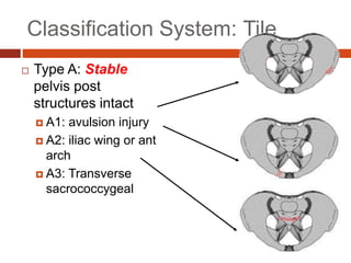 Tile
:
Classification System
 Type A: Stable
pelvis post
structures intact
 A1: avulsion injury
 A2: iliac wing or ant
arch
 A3: Transverse
sacrococcygeal
 