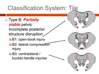 Tile
:
Classification System
 Type B: Partially
stable pelvis:
incomplete posterior
structure disruption
 B1: open-book injury
 B2: lateral compression
injury
 B3: contralateral /
bucket handle injuries
 