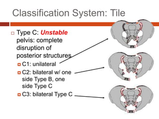 Tile
:
Classification System
 Type C: Unstable
pelvis: complete
disruption of
posterior structures
 C1: unilateral
 C2: bilateral w/ one
side Type B, one
side Type C
 C3: bilateral Type C
 