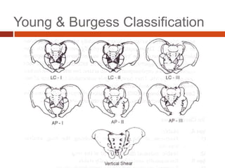 Young & Burgess Classification
 