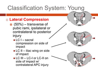 Classification System: Young
 Lateral Compression
 (50%) – transverse of
pubic rami, ipsilateral or
contralateral to posterior
injury
 LC I – sacral
compression on side of
impact
 LC II – iliac wing on side
of impact
 LC III – LC-I or LC-II on
side of impact w/
contralateral APC injury
 