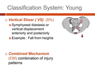 Classification System: Young
 Vertical Shear ( VS) (5%)
 Symphyseal diastasis or
vertical displacement
anteriorly and posteriorly
 Example : Fall from heights
 Combined Mechanism
(CM) combination of injury
patterns
 