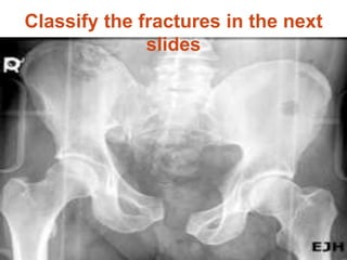 Classify the fractures in the next
slides
 
