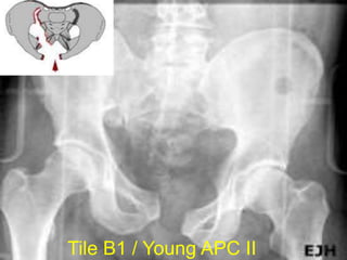 Tile B1 / Young APC II
 