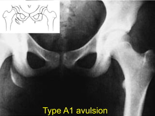Type A1 avulsion
 