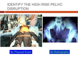 IDENTIFY THE HIGH RISK PELVIC
DISRUPTION
By Physical Exam By Radiography
 