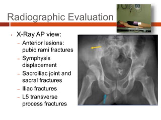 Radiographic Evaluation
• X-Ray AP view:
– Anterior lesions:
pubic rami fractures
– Symphysis
displacement
– Sacroiliac joint and
sacral fractures
– Iliac fractures
– L5 transverse
process fractures
 