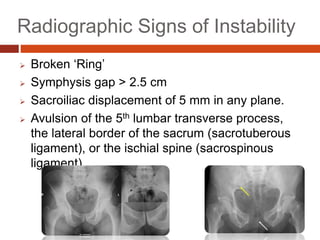 Radiographic Signs of Instability
 Broken ‘Ring’
 Symphysis gap > 2.5 cm
 Sacroiliac displacement of 5 mm in any plane.
 Avulsion of the 5th lumbar transverse process,
the lateral border of the sacrum (sacrotuberous
ligament), or the ischial spine (sacrospinous
ligament).
 