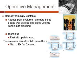 Operative Management
 Hemodynamically unstable
 Reduce pelvic volume : promote blood
clot as well as reducing blood volume
from inside bleeding
 Technique
 First aid : pelvic wrap
(This is wrapped circumferentially around the pelvis)
 Next : Ex fix/ C clamp
 