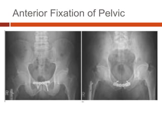 Anterior Fixation of Pelvic
 