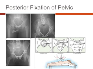 Posterior Fixation of Pelvic
 