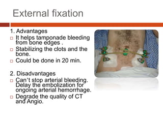 External fixation
1. Advantages
 It helps tamponade bleeding
from bone edges .
 Stabilizing the clots and the
bone.
 Could be done in 20 min.
2. Disadvantages
 Can’t stop arterial bleeding.
Delay the embolization for
ongoing arterial hemorrhage.
 Degrade the quality of CT
and Angio.
 