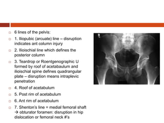  6 lines of the pelvis:
 1. Iliopubic (arcuate) line – disruption
indicates ant column injury
 2. Ilioischial line which defines the
posterior column
 3. Teardrop or Roentgenographic U
formed by roof of acetabaulum and
ilioischial spine defines quadrangular
plate – disruption means intraplevic
penetration
 4. Roof of acetabulum
 5. Post rim of acetabulum
 6. Ant rim of acetabulum
 7. Shenton’s line = medial femoral shaft
 obturator foramen: disruption in hip
dislocation or femoral neck #’s
 