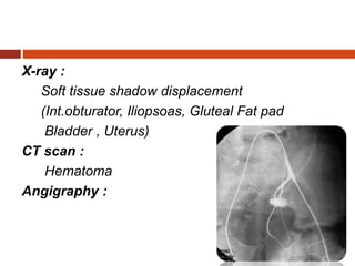 X-ray :
Soft tissue shadow displacement
(Int.obturator, Iliopsoas, Gluteal Fat pad
Bladder , Uterus)
CT scan :
Hematoma
Angigraphy :
 