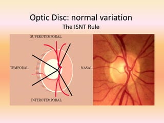 Optic Disc: normal variation
The ISNT Rule
 
